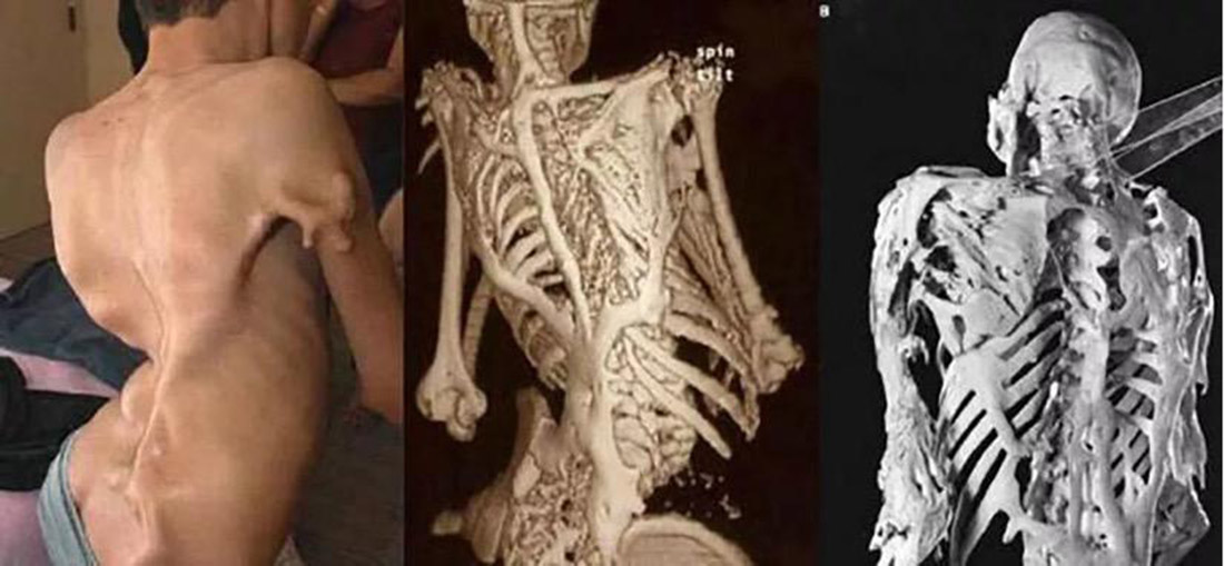 Fibrodysplasia Ossificans Progressiva (FOP) – "Kost u mesu"